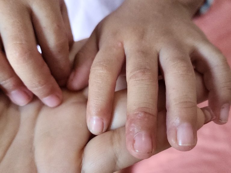 SSM descarta brote de virus de Coxsackie en la entidad